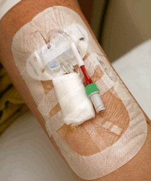 Photograph-of-a-PICC-line-on-an-arm